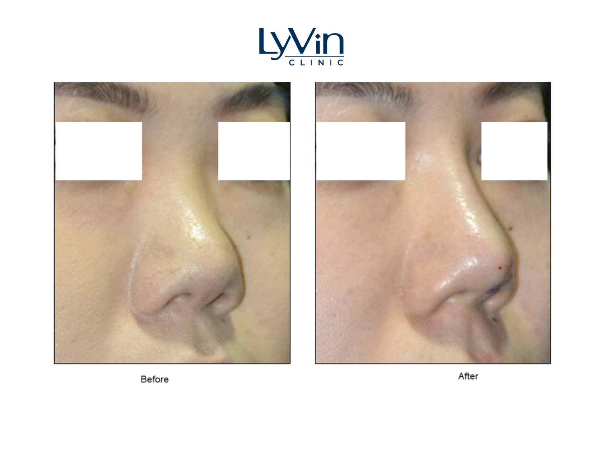 Nose Filler in Johor Bahru | Lyvin Clinic JB